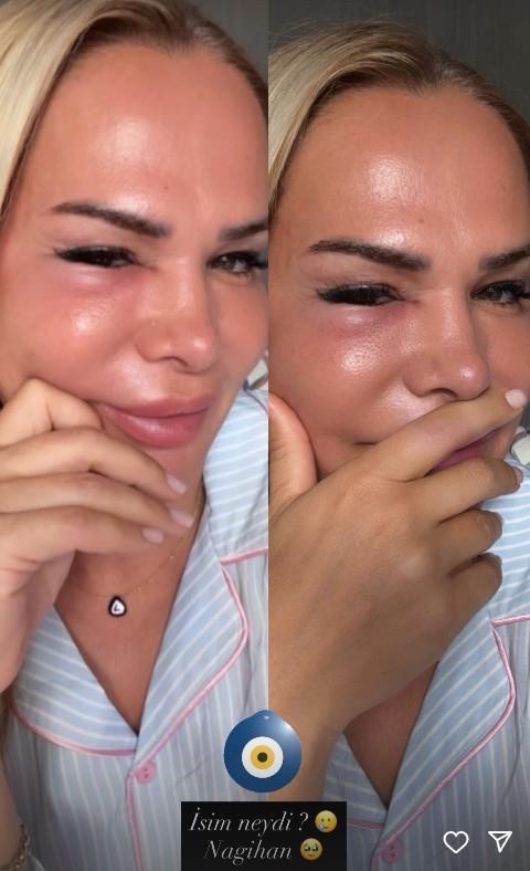 Nagihan Karadere showing her swollen face on Instagram