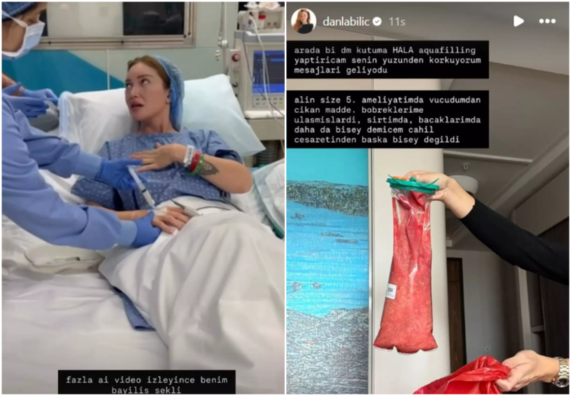 Filler removed from Danla Bilic's body